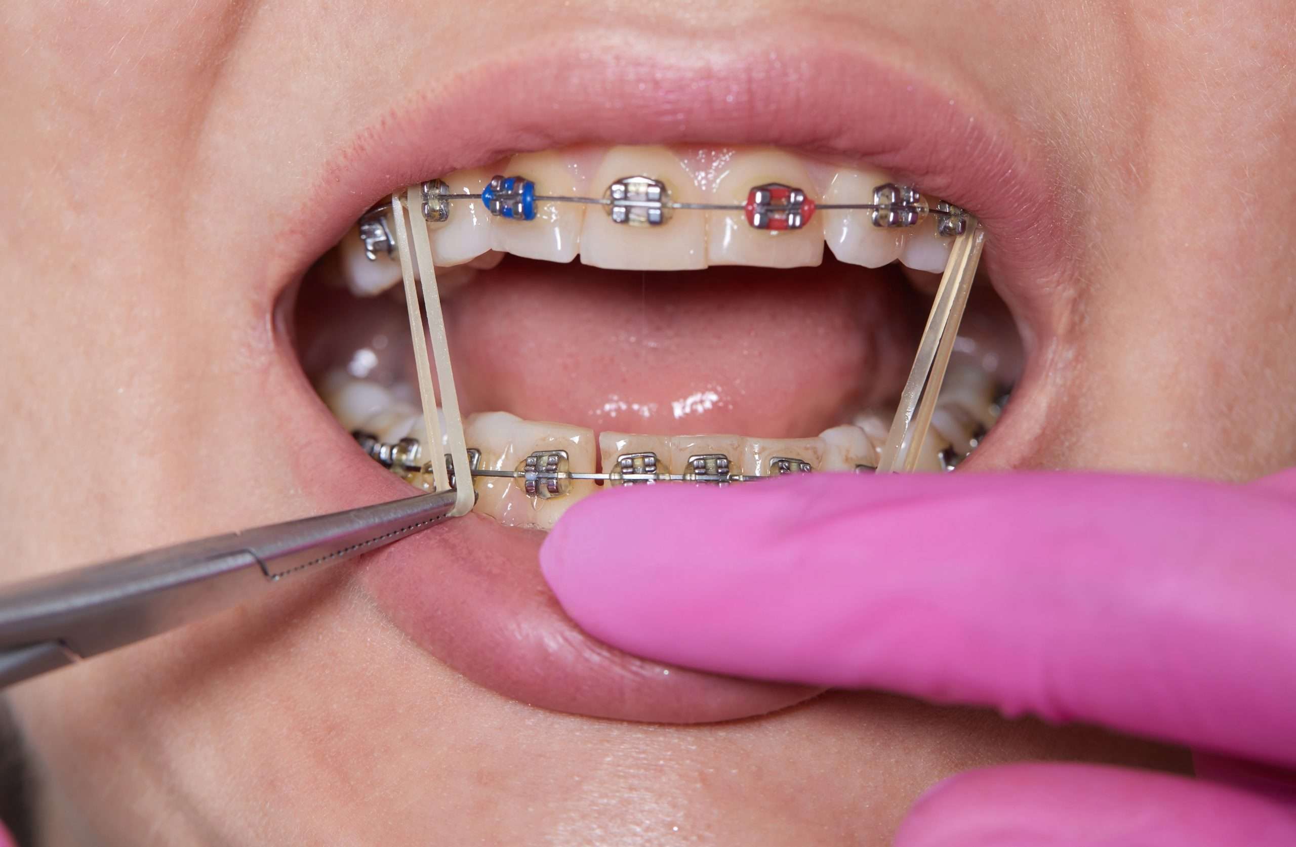 Orthodontic Treatments for Kids & Adults in Kendall, FL